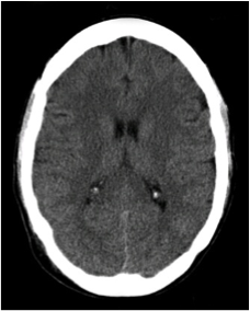 Coupe transverse du cerveau par IRM